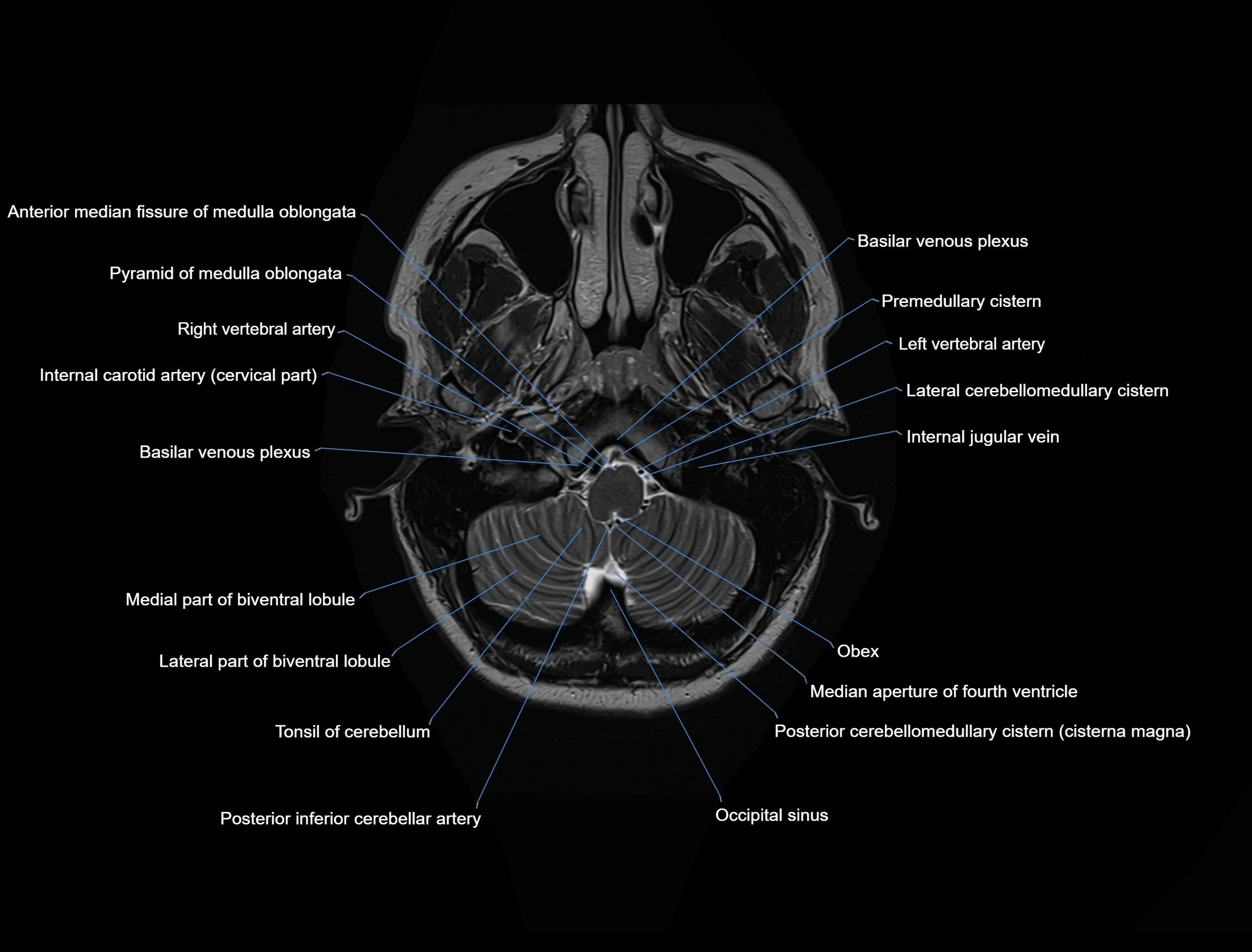 MRI Brain axial cross sectional radiology anatomy 3T image  -img-00001-00006.webp